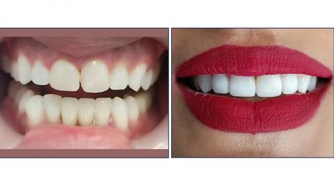 Composite veneers